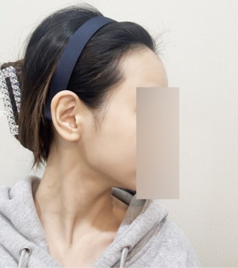 절개모발이식 뒷머리 흉터 얼마나 남나요 &ndash; 후기&middot;부작용 현실 정리 관련 이미지 4