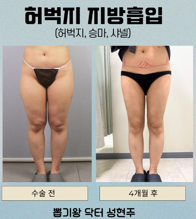 강남다이어트병원, 살은 빠졌는데 라인이 그대로인 이유는? 관련 이미지 6