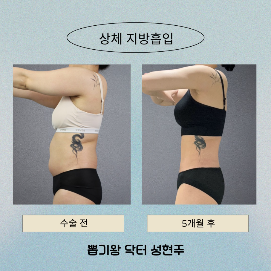 허리지방흡입 고민이라면, 운동으로 안 빠지는 옆구리 해결될까? 관련 이미지 6
