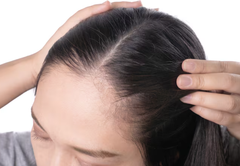 강남 여성 모발이식 병원 추천 기준 무엇일까? 헤어라인 디자인과 시술 방법 설명률&middot;자연스러움 관련 이미지 2