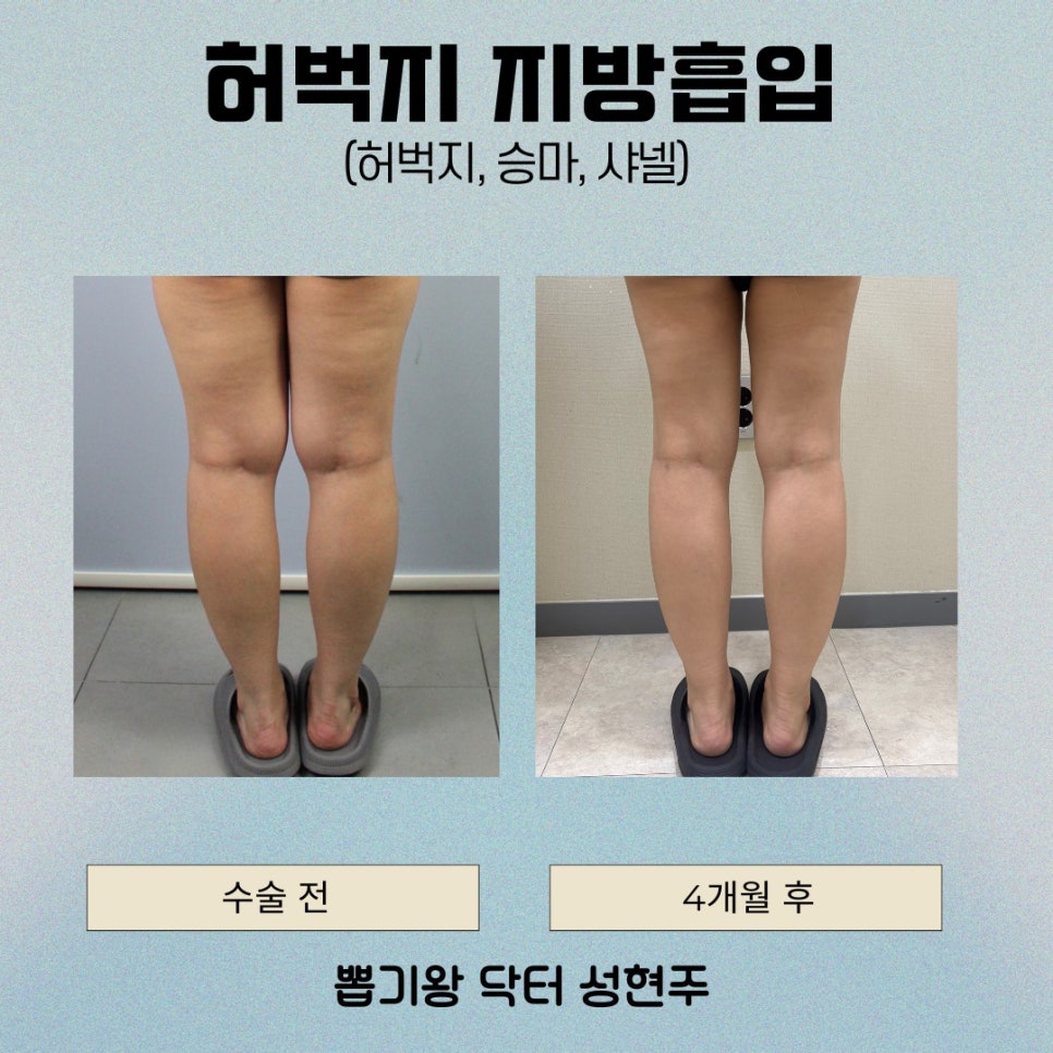 Bruising · Swelling · Dimpling After Thigh Liposuction—Are They Part of the Normal Recovery Process? image 2