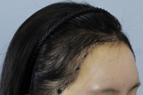 Hair Transplant Take-In Period: When Will the Grafts Fully Settle? A Complete Overview of Changes by Stage image 7