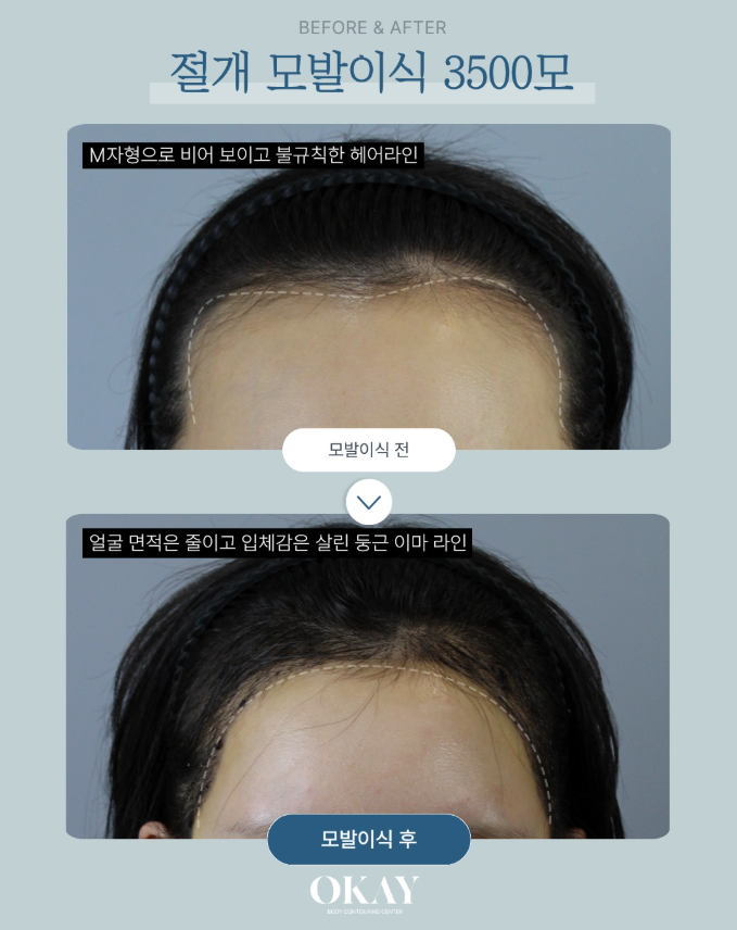 Gangnam Hair Loss Clinic: There Are Specific Cases When Hair Transplantation Is Necessary image 7