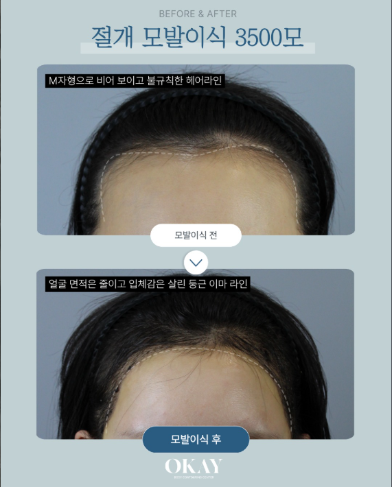 여자헤어라인모발이식 효과 언제부터 보일까? 생착 시기&middot;회복기간 설명 관련 이미지 8