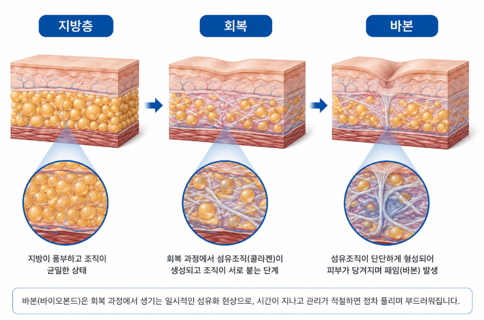 Post-Liposuction Lumpiness Management: Essential Care Tips for Reducing Hardness image 3