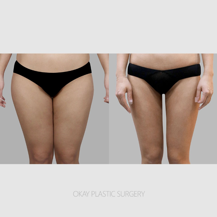 허벅지지방흡입, 다리가 두꺼워 보이는 이유가 지방 때문일까? 관련 이미지 4