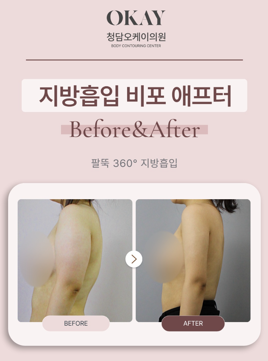 전신지방흡입, 한 번에 여러 부위 진행해도 괜찮을까요? 관련 이미지 5