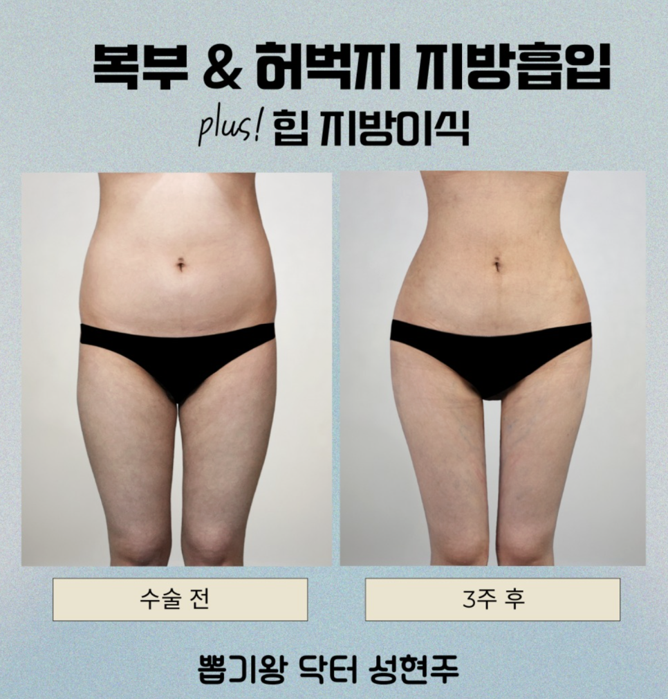 What Is the Waist-Hip Ring Procedure, and How Does It Differ from Liposuction? image 2