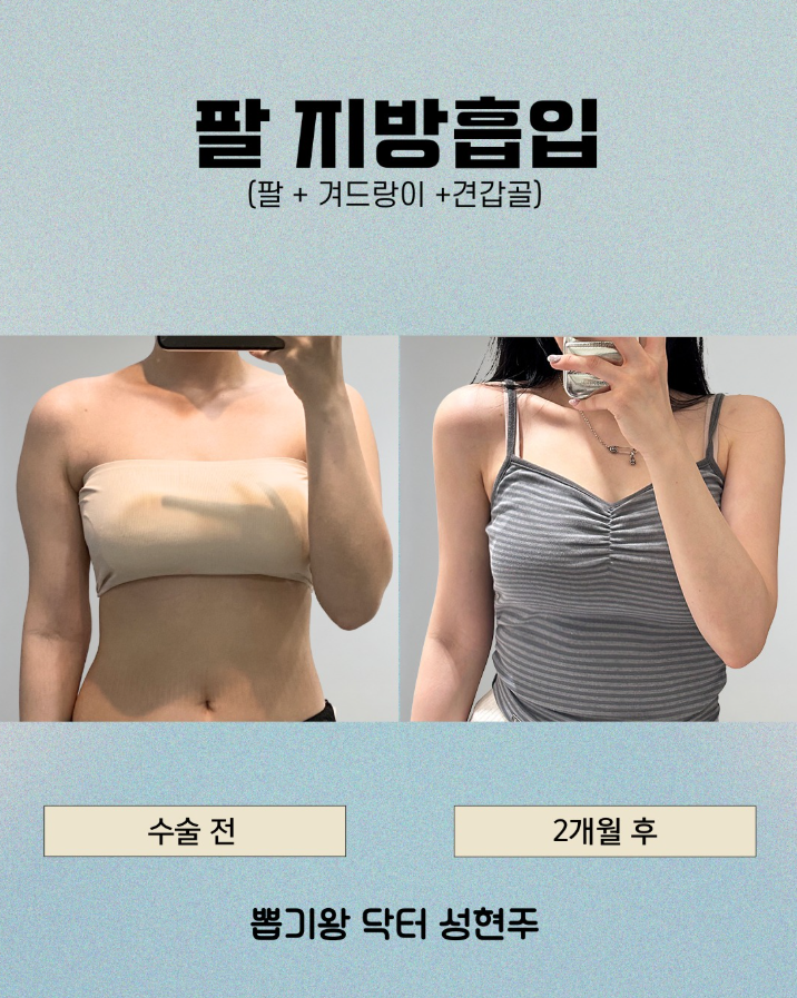 강남다이어트병원, 살은 빠졌는데 라인이 그대로인 이유는? 관련 이미지 5