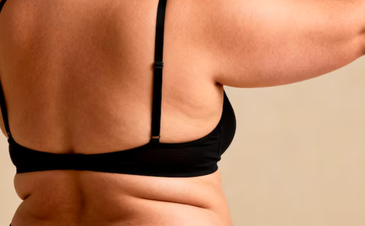 팔뚝지방흡입수술비용, 겨드랑이·부유방까지 하면 얼마나 달라질까? 관련 이미지 7