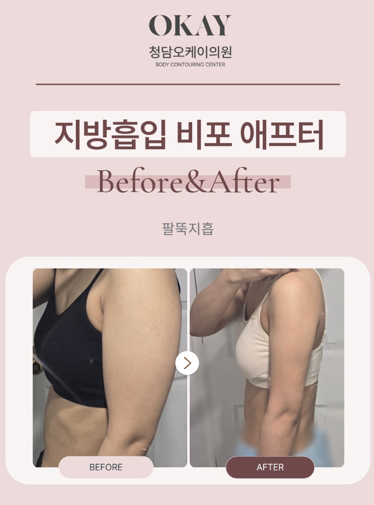 상체지방흡입, 팔뚝·등·옆구리까지 같이 해야 할까요? 관련 이미지 5