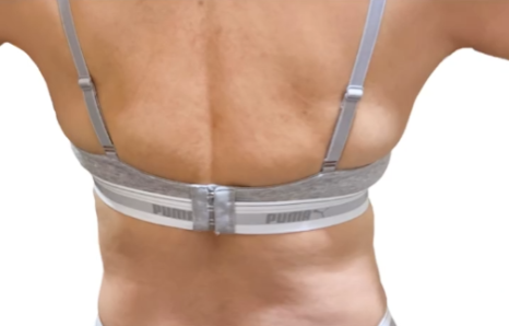 How to Find a Good Liposuction Clinic Near Gangnam Station: Hospital Selection Criteria and the Difference Between Reviews and Actual Results image 7