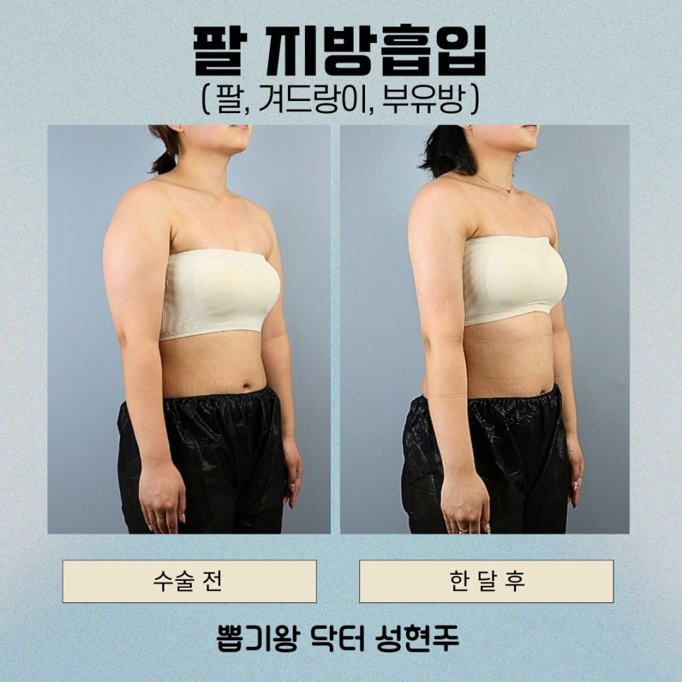 팔뚝지방흡입후관리, 결과를 오래 유지하려면 이것부터 확인하세요 관련 이미지 10
