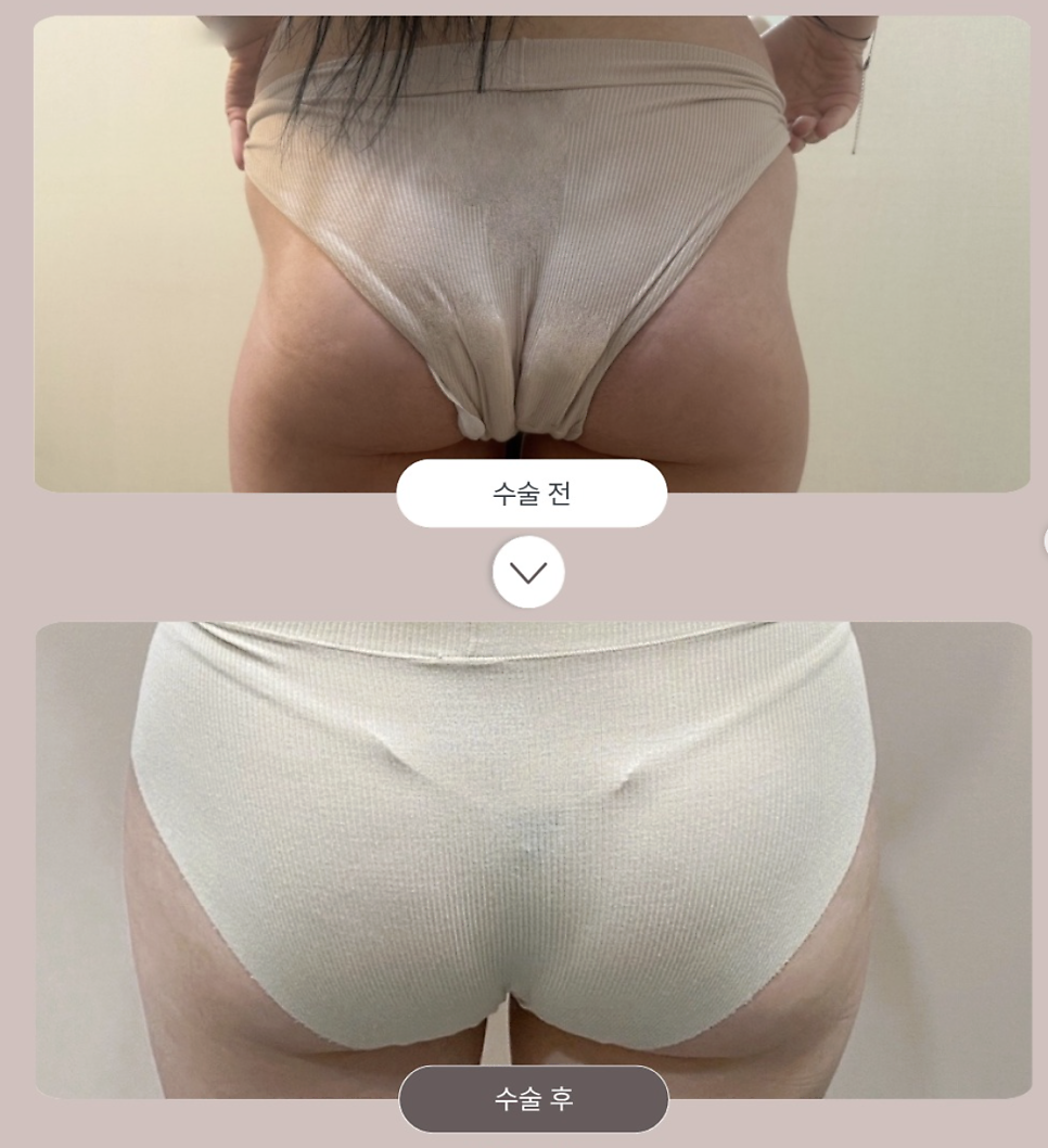힙딥지방이식, 운동으로 안 채워지는 골반 옆 꺼짐 개선 방법은? 관련 이미지 10