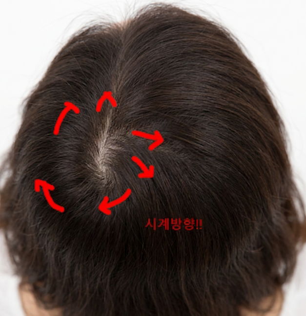 Female Crown Hair Transplantation: Explaining Why Results and Graft Survival Rates Differ image 3