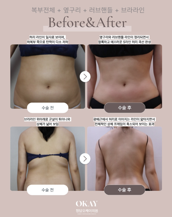 지방흡입잘하는병원 찾는다면? 부위보다 중요한 건 전체 라인 관련 이미지 7