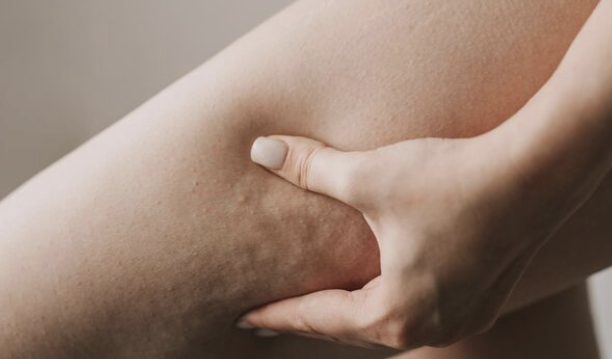 하체비만 허벅지지방흡입, 살을 빼도 허벅지가 그대로라면? 관련 이미지 6