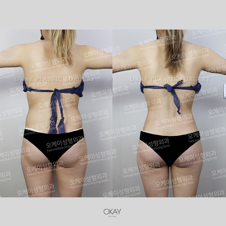 복부지방흡입가격, 비용보다 먼저 봐야 할 복부 라인의 차이 관련 이미지 8