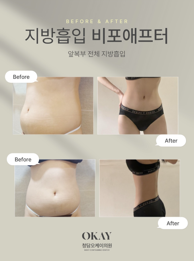 지방흡입가격 저렴한 곳만 찾다가 재수술 고민하는 경우도 있습니다 관련 이미지 9