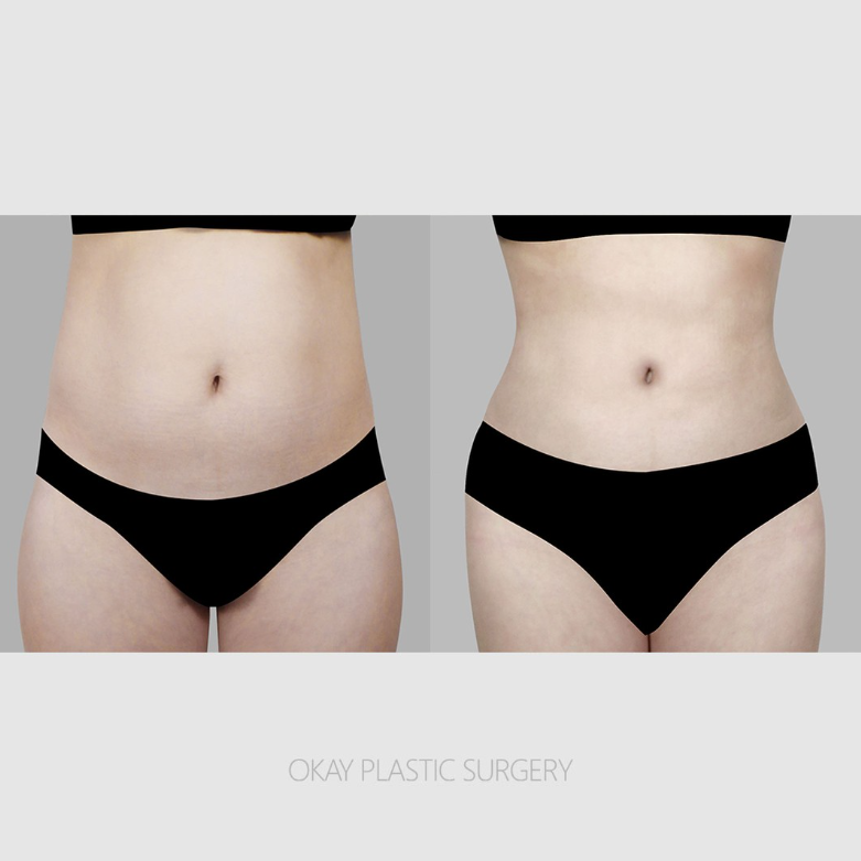 Liposuction Side Effects: What Determines Satisfaction Is Not the Amount Removed image 8