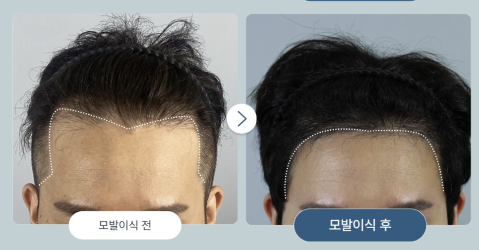 Incision vs. Non-Incision Hair Transplantation: A Complete Guide to the Differences and Selection Criteria image 10