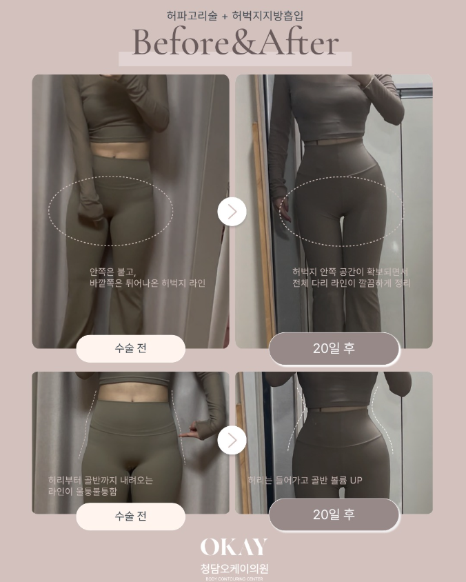 지방흡입통증 고민 중이라면? 가장 아픈 시기부터 확인하세요 관련 이미지 9