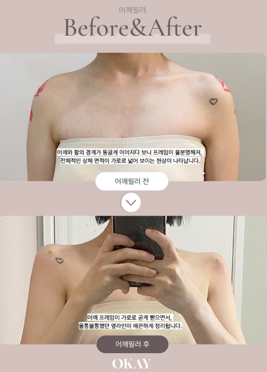 어깨필러, 직각어깨를 원한다면 라인부터 확인해야 하는 이유 관련 이미지 6