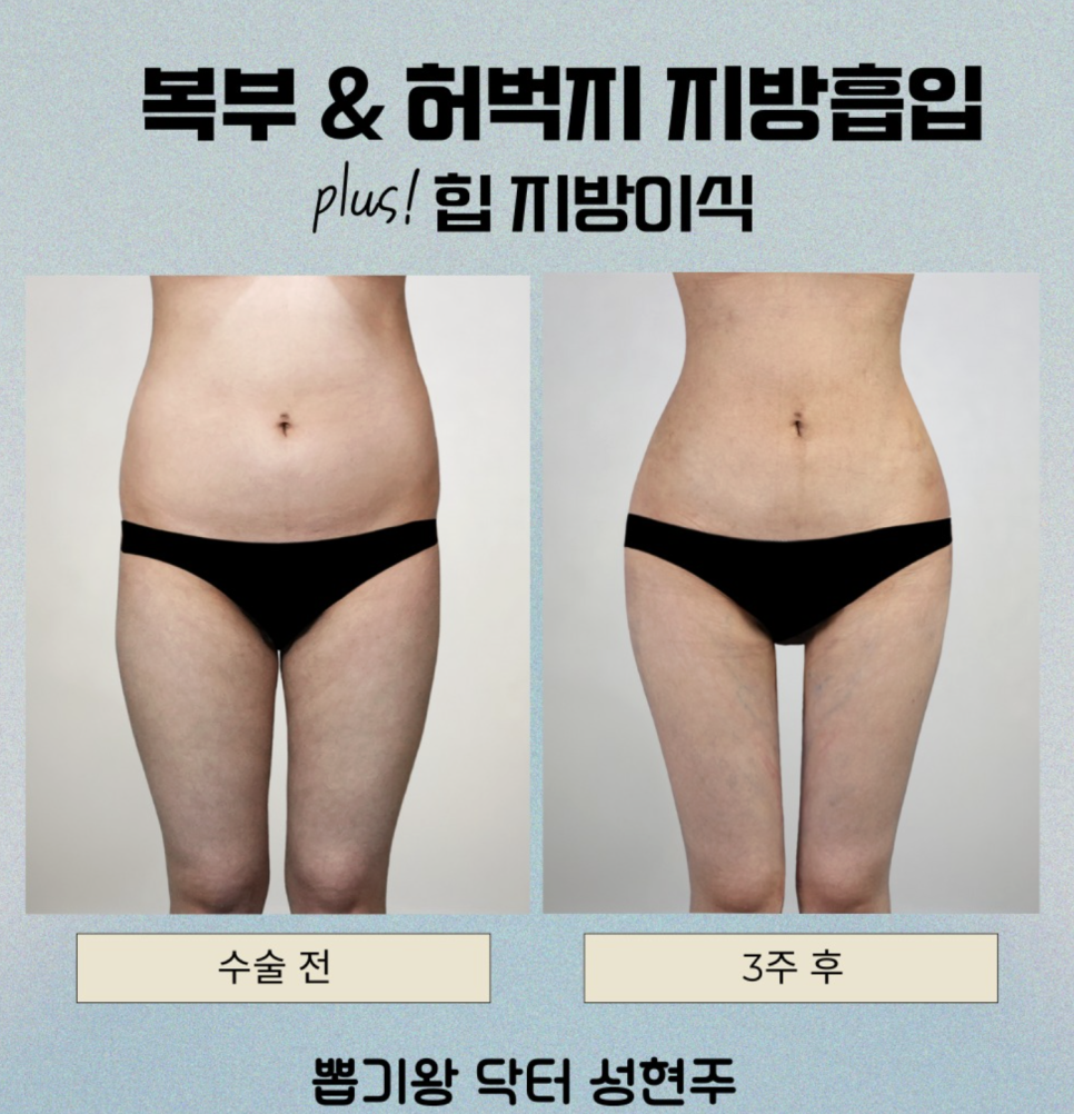 허벅지지방흡입 출근, 며칠부터 가능할까요? 회복 과정 함께 알아보기 관련 이미지 10