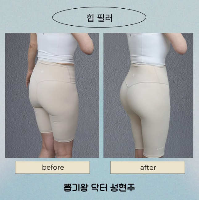 How Long Does Pelvic Filler Last? Body Shape Changes and Effects Explained image 5
