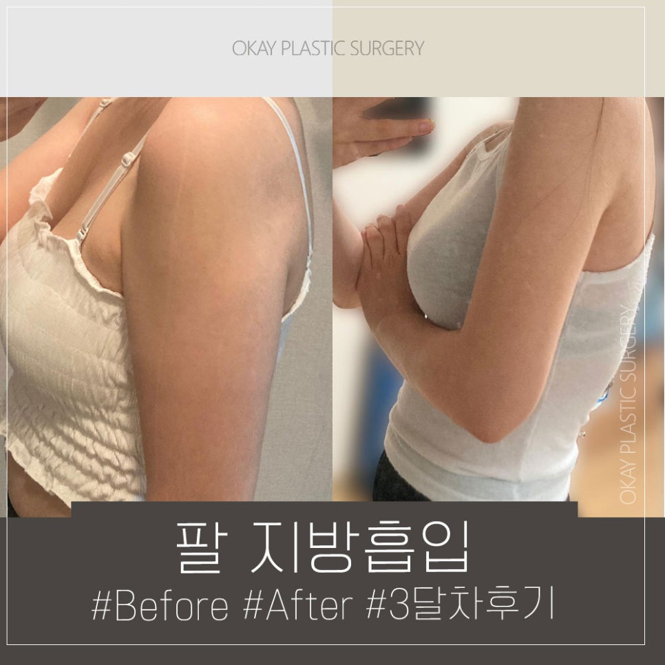 압구정로데오 성형외과 지방흡입&middot;지방이식 잘하는곳, 효과와 통증&middot;붓기&middot;멍 정리 관련 이미지 6