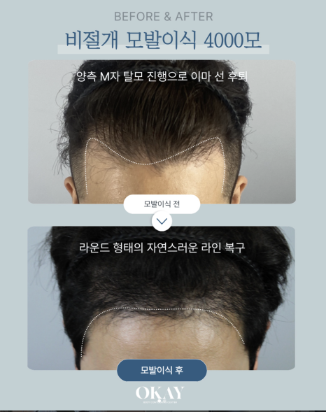 M자헤어라인모발이식 후 바로 출근 가능할까? 통증부터 회복기간까지 꼭 알아야 할 정보 총정리 관련 이미지 9