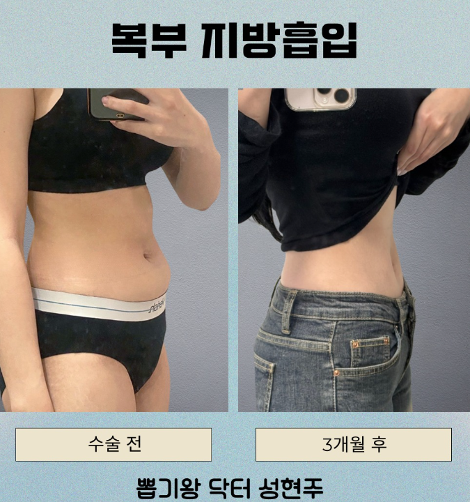 아랫배빼는법, 복부지방은 무조건 많이 빼면 될까? 관련 이미지 7