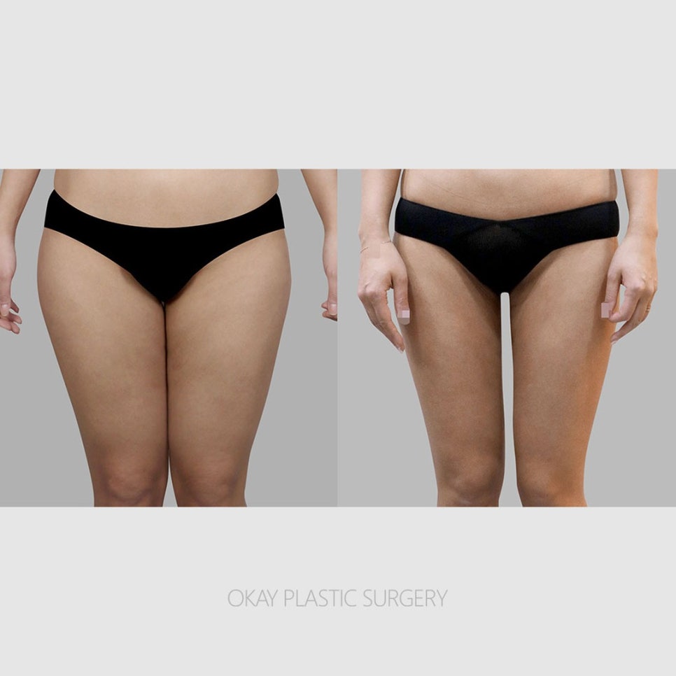 다리지방흡입 후기마다 결과가 다른 진짜 이유 관련 이미지 5