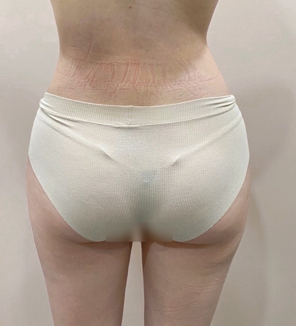 Buttock Fat Grafting vs. Implants: Which Is Better? Comparing Naturalness and Differences in Side Effects image 6