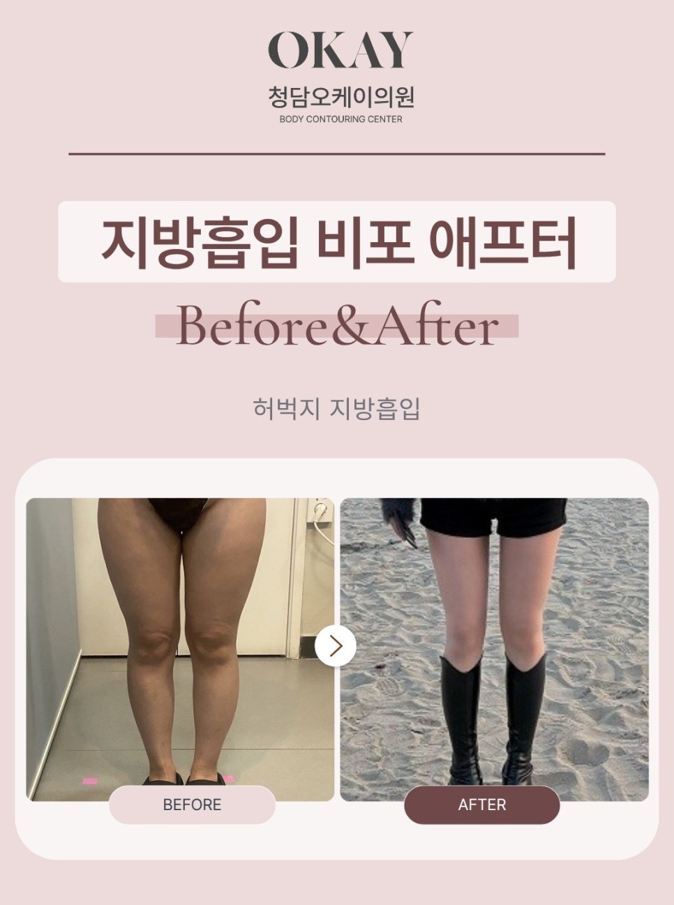 Why Satisfaction Differs After Thigh Liposuction: What You Miss When You Focus Only on the Inner Thighs image 2
