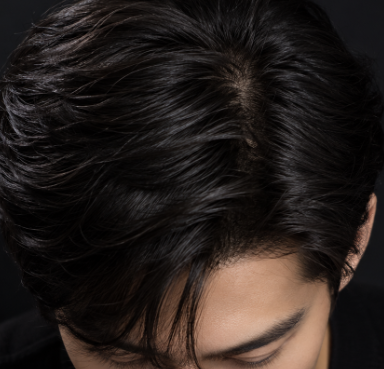 정수리모발이식, 앞머리보다 결과가 늦게 나타나는 이유는? 관련 이미지 5