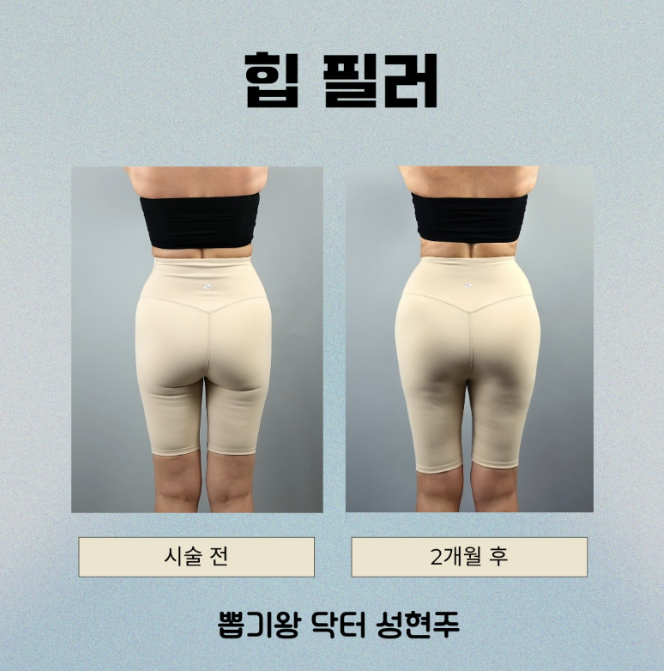 힙필러 용량, 많이 넣는다고 예뻐지는 건 아닙니다 관련 이미지 10