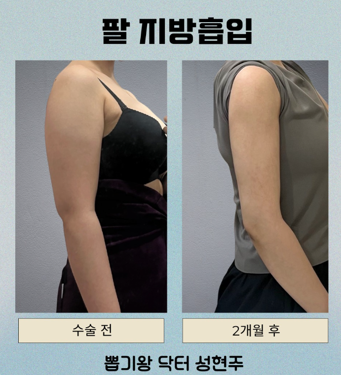팔뚝 지방분해주사 vs 지방흡입, 효과 차이는 얼마나 날까요? 관련 이미지 6