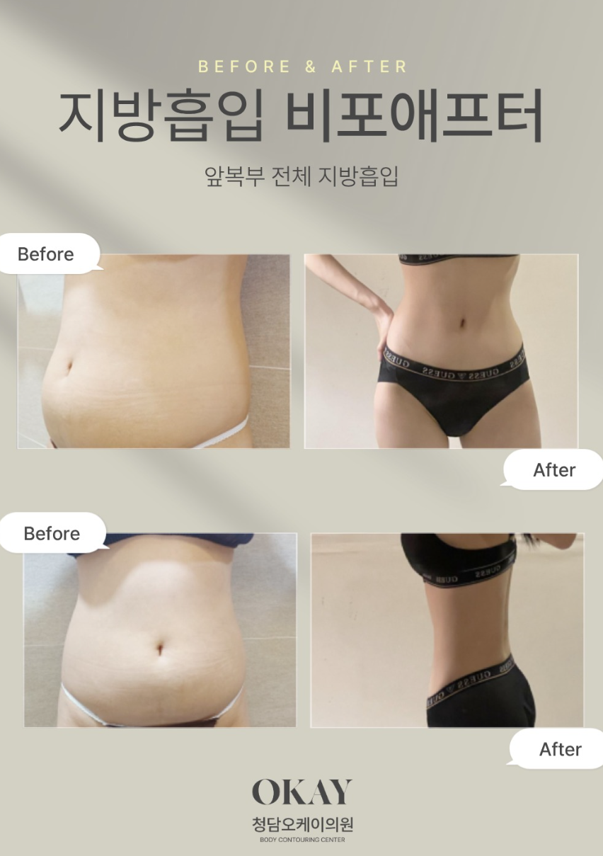 복부지방흡입 후기, 실제 허리라인은 어떻게 달라질까요? 관련 이미지 5