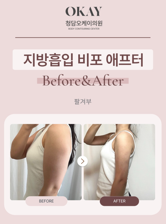 강남성형외과, 운동해도 안 빠지는 살 지방흡입이 답일까요? 관련 이미지 6