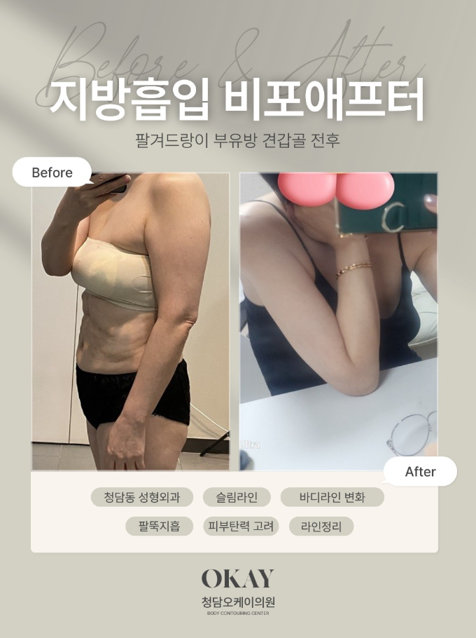 팔지방흡입 후기에서 자주 나오는 부작용 느낌, 왜 생길까요? 관련 이미지 8
