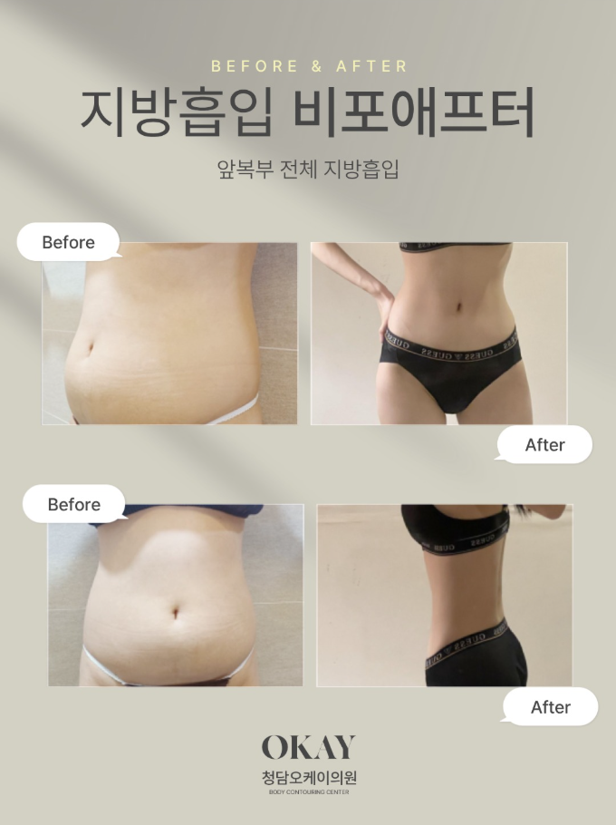 Why Are There So Many Reviews About Pain After Abdominal Liposuction? Is It Because of Compression Garments and Postural Discomfort? image 8