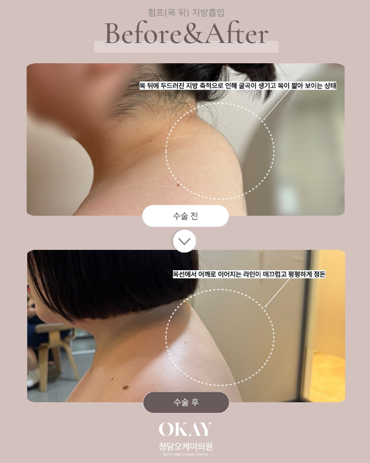 Will You Get Uneven Lumps If You Don’t Do Post-Liposuction Care? A Frequently Asked Question image 6