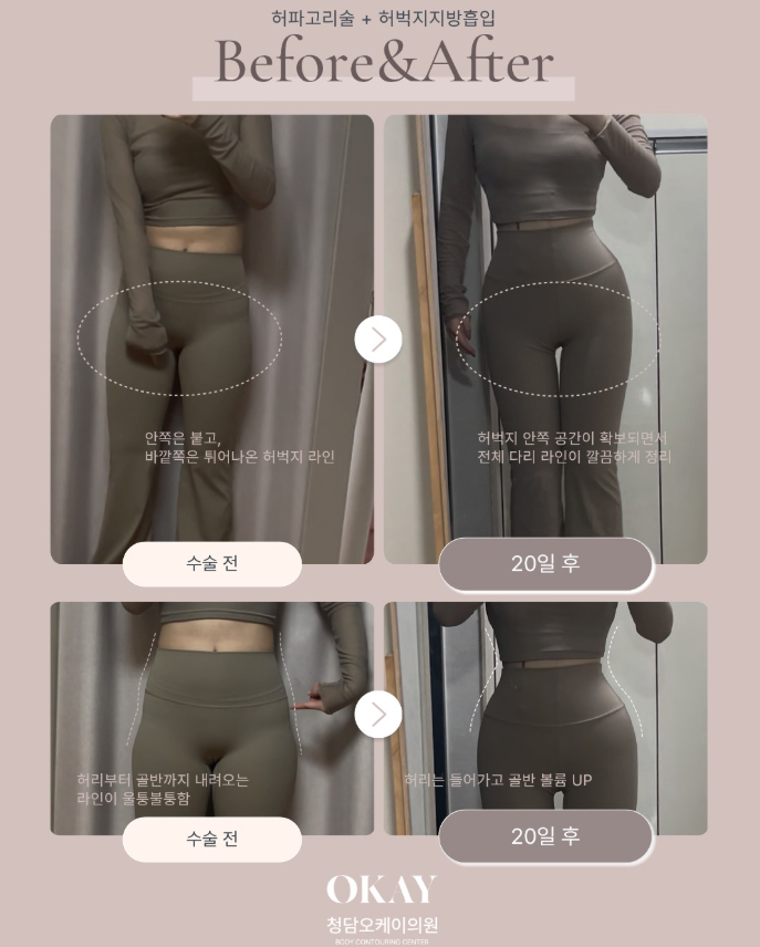 골반지방이식 후기, 만족한 사람들은 무엇이 달랐을까요? 관련 이미지 5
