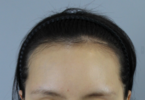 M자 헤어라인모발이식, 재수술로 이어지는 대표적인 실수 관련 이미지 9