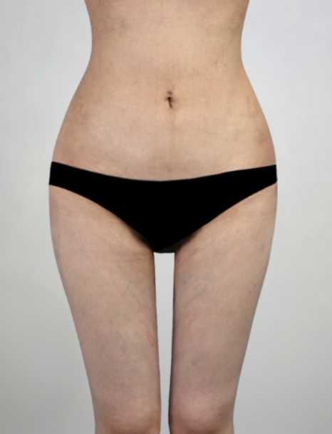 허파고리술가격, 후회하지 않으려면 확인해야 할 4가지 관련 이미지 3