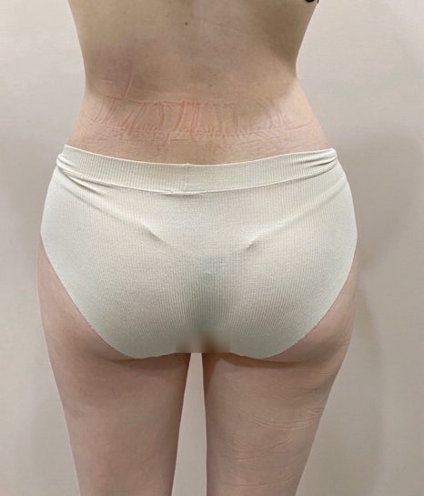 서울지방이식잘하는곳 왜 차이 날까? 가격·효과·후기 그리고 부작용 체크 관련 이미지 11