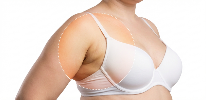 Accessory Breast Liposuction: Price, Side Effects, Swelling, Compression Garments, and Recurrence Explained image 2