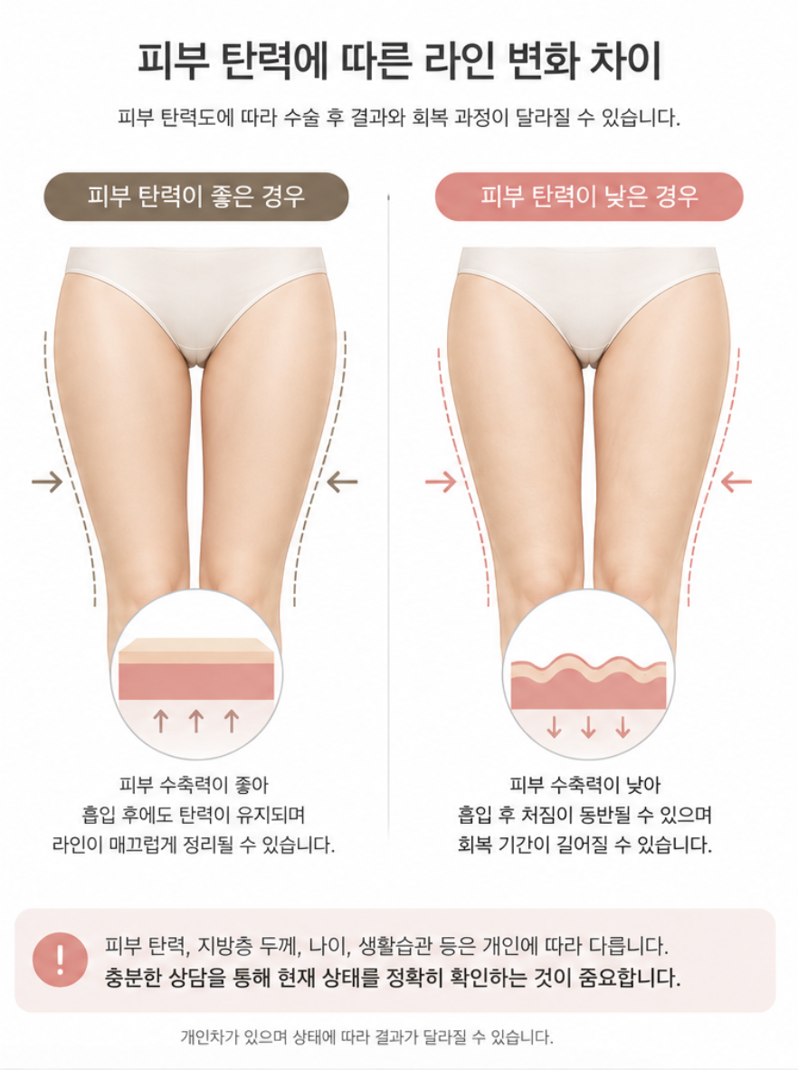 Why Satisfaction Differs After Thigh Liposuction: What You Miss When You Focus Only on the Inner Thighs image 8