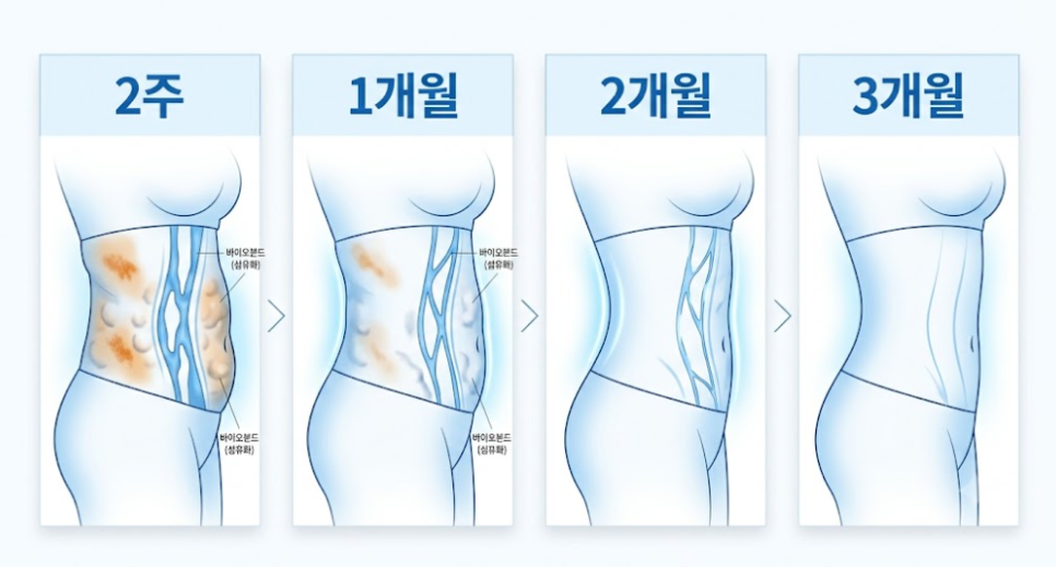 Post-Liposuction Lumpiness Management: Essential Care Tips for Reducing Hardness image 9